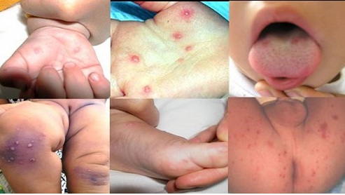 Bệnh Tay, Chân, Miệng - Những dấu hiệu cần phát hiện sớm và cách phòng tránh